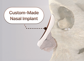 SOFIT custom implant design