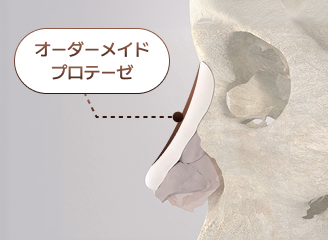 SOFITオーダーメイドインプラント設計