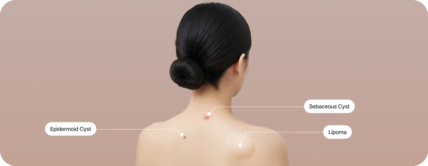 Benign tumors