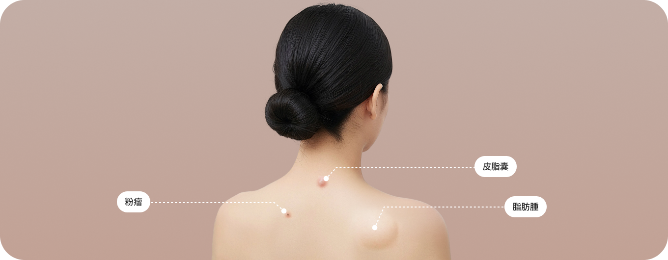 良性腫瘍