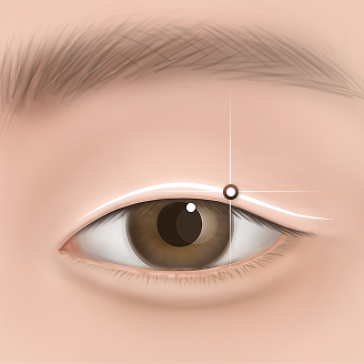 부기와 멍의 최소화