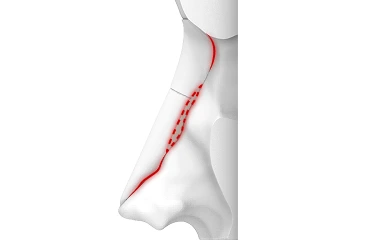 기성 보형물 관련 사진