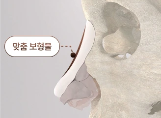 쏘핏(SOFIT) 맞춤형 보형물 설계